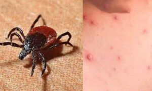 Scrub Typhus Scare: ପାଲଲହଡ଼ାରେ ସ୍କ୍ରବ୍ ଟାଇଫସ୍ ଆତଙ୍କ: ୨ ଦିନରେ ୨୯ ନୂଆ ପଜିଟିଭ୍ ଚିହ୍ନଟ